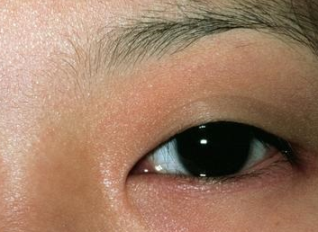 激光祛眼袋可靠嗎？激光去眼袋會不會留疤？