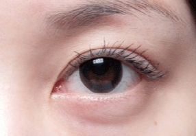 激光去眼袋會(huì)不會(huì)很疼？