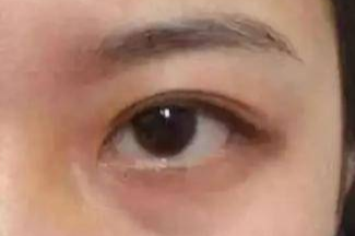 激光祛眼袋效果真的好嗎？激光去眼袋會有風險嗎？