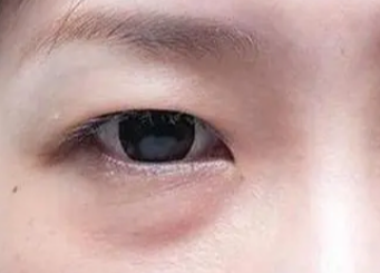 激光去眼袋要多長時間？做激光去眼袋手術要多久？