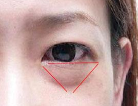 激光除眼袋效果如何？激光去眼袋要注意什么？