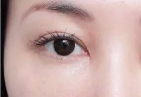 激光去眼袋什么人適合？