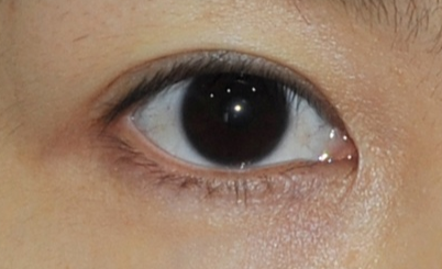 遵義韓美整形醫(yī)院開(kāi)眼角怎么樣？開(kāi)眼角的價(jià)格是多少？