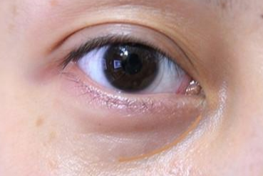 激光去眼袋多長時間能消腫？激光去眼袋能維持幾年？