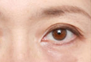 激光去眼袋幾天能恢復？激光去眼袋是怎樣的？