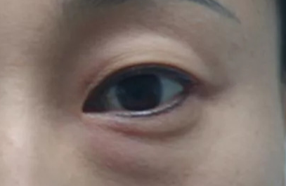 激光去除眼袋效果好不好？