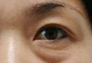 激光去眼袋會反彈嗎？