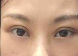 激光去眼袋可保持多久？