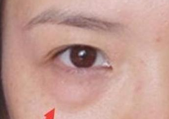 激光去眼袋的效果怎么樣？激光去眼袋注意事項(xiàng)有哪些？