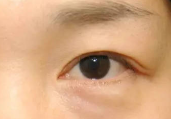 激光去眼袋術后會不會反彈？激光去眼袋術后注意事項？