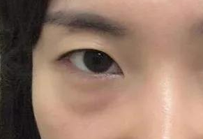 激光去眼袋有什么危害？激光去眼袋幾天能消腫？