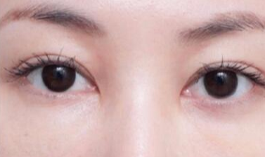 激光去眼袋安全嗎？