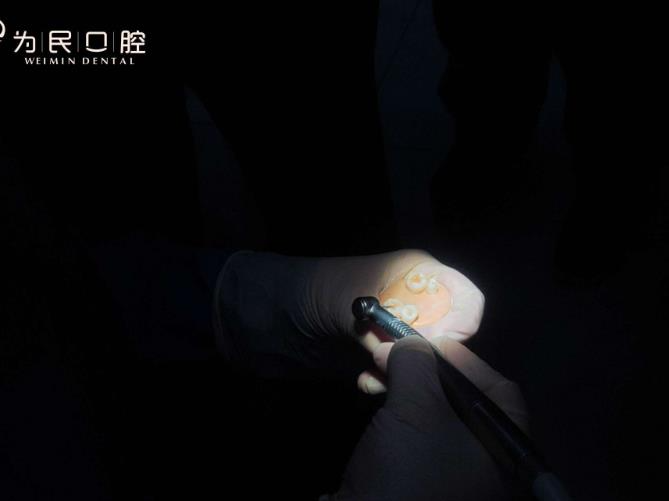 宣城為民口腔門診部_牙齒種植