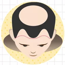 五級(jí)脫發(fā)