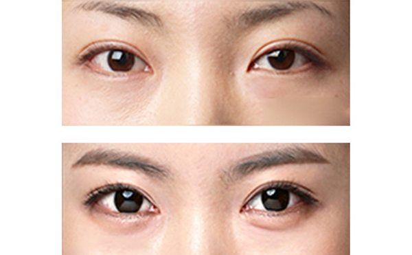 “眼瞼嫵媚術(shù)”是什么?怎么做?