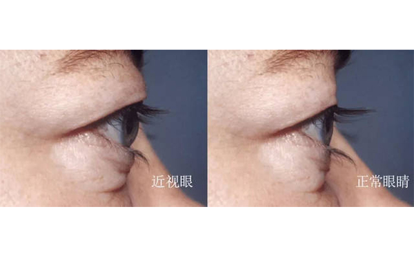 眼球突出矯正術(shù)安全嗎?術(shù)后會不會復(fù)發(fā)?