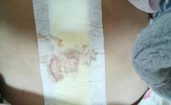 自體脂肪豐臀有副作用嗎?有什么風險?