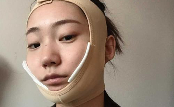 下頜角形術(shù)后注意事項