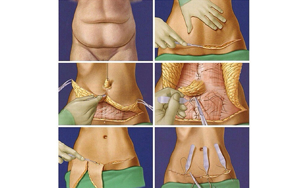 什么是腹壁成形術(shù)?手術(shù)過程是什么?