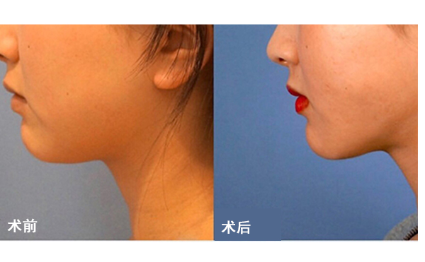 面部吸脂后皮膚會(huì)不會(huì)松弛？