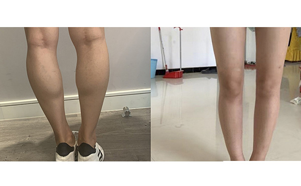 瘦腿針和吸脂哪個(gè)好？