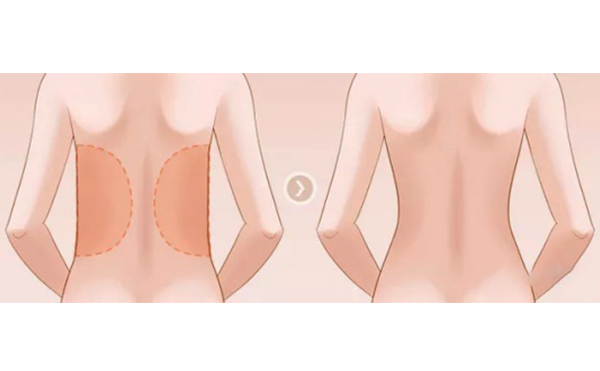 背部吸脂手術(shù)的關(guān)鍵在哪個(gè)部位？