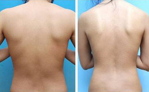 瘦肩針的副作用有哪些?一針大概多少錢?