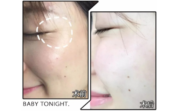 玻尿酸去魚尾紋有哪些優(yōu)點？