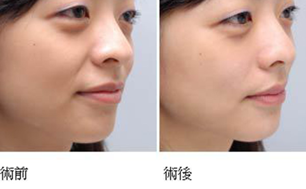 玻尿酸去法令紋需要多久能恢復(fù)？