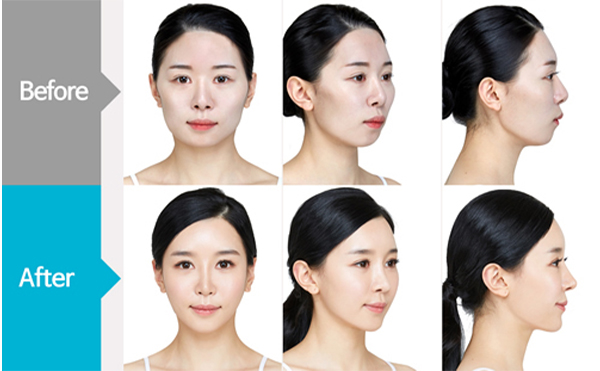 改臉型手術(shù)哪家好？