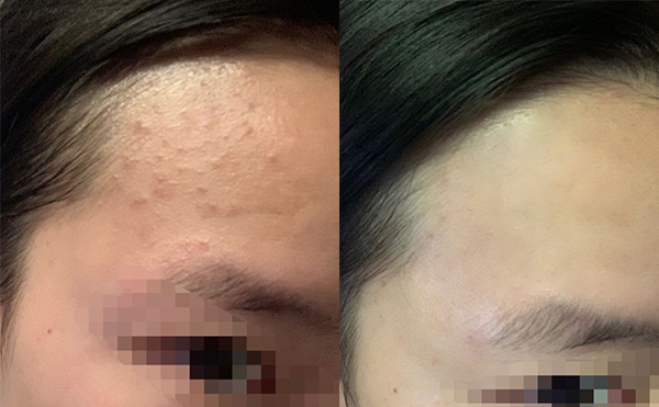 果酸煥膚后皮膚會變薄嗎？