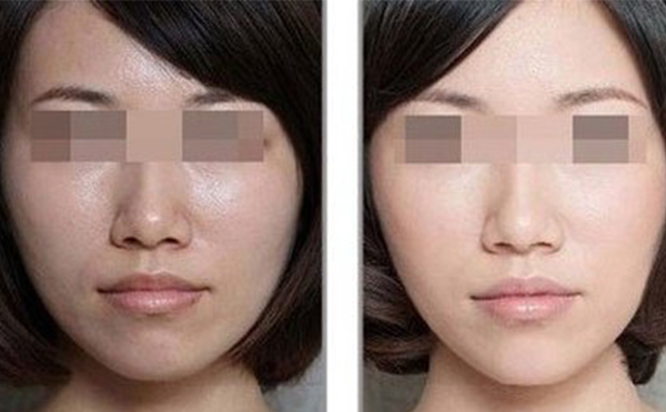 美白針的效果怎么樣？