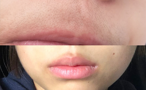 激光面部脫毛能脫得干凈嗎？