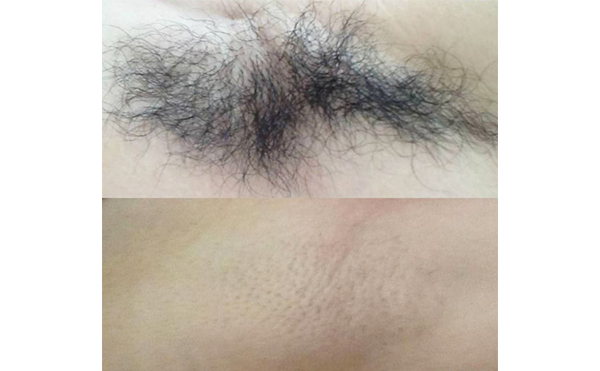 激光脫腋毛疼嗎？