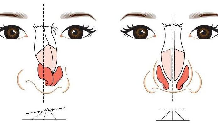 鼻子歪矯正大約多少錢？鼻子歪矯正恢復(fù)期多久？