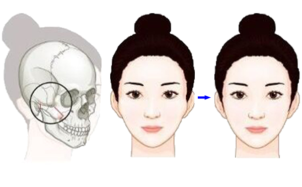 顴骨降低整形手術是怎么操作的？有什么特點？