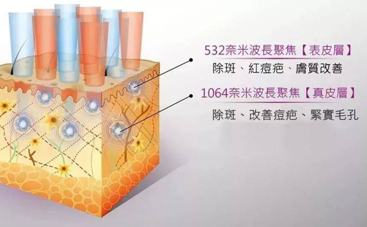 皮秒祛斑恢復(fù)期多久？