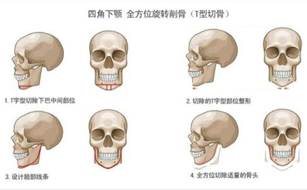 太原麗都整形專家：切下頜角手術(shù)風(fēng)險主要是這六點