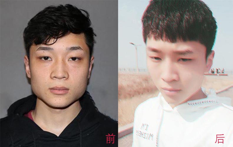 瘦臉針、面部吸脂如何選擇？