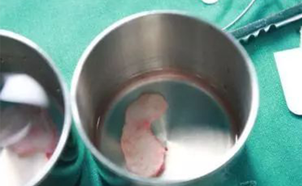 自體軟骨隆鼻是取自身體的那個(gè)部位？哪個(gè)部位的軟骨隆鼻效果更好