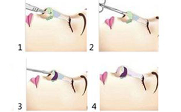 鼻小柱延長手術(shù)是怎么做的?有哪些方法?