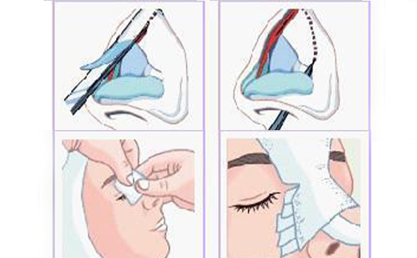 鼻小柱延長手術(shù)材料有哪些？這些材料有什么優(yōu)勢