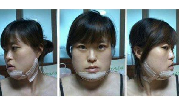 下頜角整形術(shù)后有沒有后遺癥?