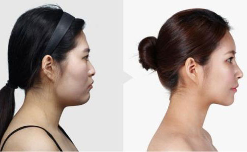 隆鼻手術(shù)多久恢復(fù)自然？