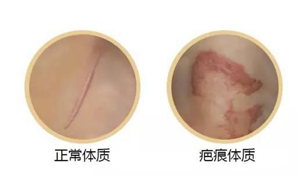 疤痕體質割雙眼皮怎么樣?如何自測疤痕體質?