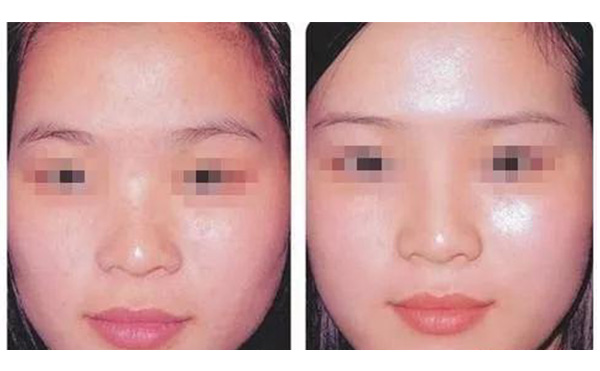 水光注射疼不疼？