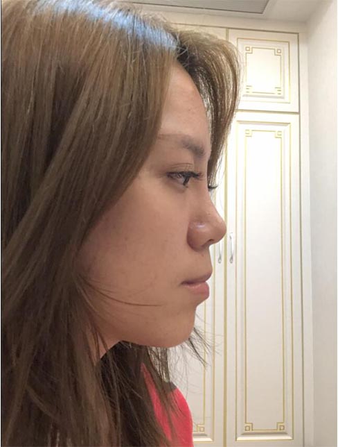 肋軟骨鼻綜合案例：術(shù)后效果