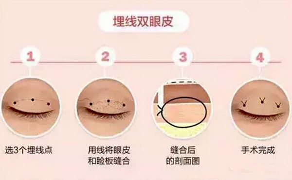 全切雙眼皮跟埋線的區(qū)別是什么？哪個(gè)好？