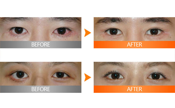 埋線雙眼皮失敗該如何修復(fù)？多久修復(fù)好？