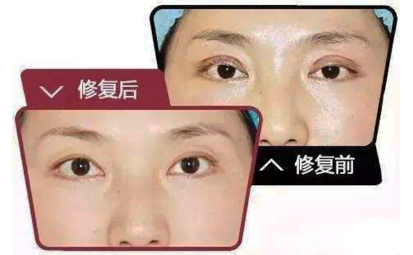 哪些情況需做雙眼皮修復(fù)？修復(fù)難度大不大?